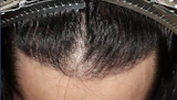 20代 男性 M.K.さん 生え際 自毛植毛（MIRAI法）1,500株の症例｜自毛植毛の症例（手術後）