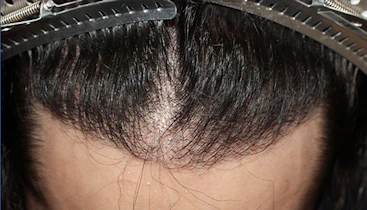 20代 男性 M.K.さん 生え際 自毛植毛（MIRAI法）1,500株の症例｜自毛植毛の症例（手術後）