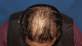 50代 男性 K.T.さん 前頭部・頭頂部 自毛植毛（MIRAI法）2,500株の症例｜自毛植毛の症例（手術前）