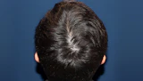 30代 男性 N.A.さん 頭頂部・つむじ 自毛植毛（MIRAI法）900株の症例｜自毛植毛の症例（手術後）
