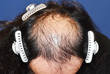 30代 男性 S.T.さん 前頭部～頭頂部 自毛植毛（MIRAI法）1,500株の症例（手術前）