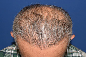50代 男性 T.M.さん 生え際・前頭部 自毛植毛（MIRAI法）1,500株の症例（術後11ヶ月の経過）