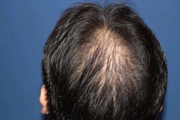 50代 男性 O.Y.さん 頭頂部 自毛植毛（MIRAI法）1,500株の症例｜自毛植毛の症例（手術後）