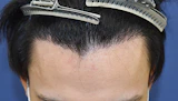 20代 男性 Y.U.さん 生え際 自毛植毛（MIRAI法）1,200株の症例｜自毛植毛の症例（手術後）