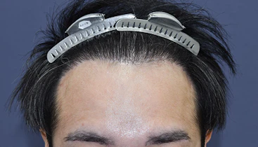 30代 男性 K.T.さん 生え際・頭頂部・つむじ 自毛植毛（MIRAI法）3,000株の症例｜自毛植毛の症例（手術後）