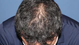 30代 男性 S.Y.さん 前頭部 頭頂部 自毛植毛（MIRAI法）2,300株の症例｜自毛植毛の症例（手術後）