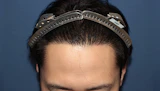 30代 男性 H.H.さん 生え際 自毛植毛（MIRAI法）1,500株の症例｜自毛植毛の症例（手術後）