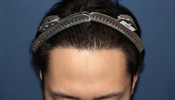 30代 男性 H.H.さん 生え際 自毛植毛（MIRAI法）1,500株の症例｜自毛植毛の症例（手術後：正面）