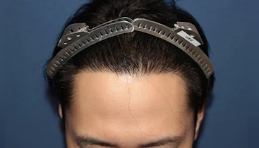 30代 男性 H.H.さん 生え際 自毛植毛（MIRAI法）1,500株の症例｜自毛植毛の症例（手術後）