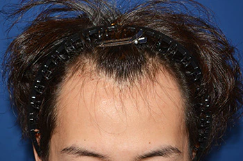 20代 男性 S.T.さん 生え際 自毛植毛（MIRAI法） 2,000株の症例｜自毛植毛の症例（手術前の状態）