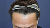 50代 男性 O.S.さん 生え際 自毛植毛（MIRAI法）1,000株の症例｜自毛植毛の症例（手術後）