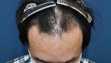 40代 男性  S.T.さん 生え際・前頭部 自毛植毛（MIRAI法）1,800株の症例｜自毛植毛の症例（手術前）