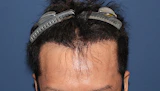30代 男性 T.W.さん 生え際 自毛植毛（MIRAI法）1,700株の症例｜自毛植毛の症例（手術後）