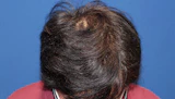 40代 男性 T.N.さん 頭頂部 自毛植毛（MIRAI法）1,600株の症例｜自毛植毛の症例（手術後）