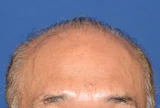 50代 男性 T.M.さん 生え際・前頭部 自毛植毛（MIRAI法）1,500株の症例｜自毛植毛の症例（手術前）