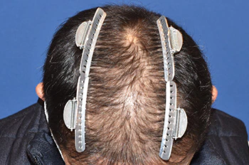 40代 男性 N.Y.さん 前頭部・頭頂部 自毛植毛（MIRAI法）2,000株の症例（術後6ヶ月の経過）