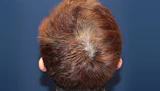 30代 男性 N.A.さん 頭頂部・つむじ 自毛植毛（MIRAI法）900株の症例｜自毛植毛の症例（手術前）