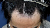 20代 男性 T.T.さん 生え際 自毛植毛（MIRAI法）1,500株の症例｜自毛植毛の症例（手術前）