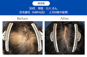 50代 男性 O.Y.さん／頭頂部の自毛植毛(MIRAI法)／2,500株の症例