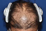 40代 男性 N.Y.さん 前頭部・頭頂部 自毛植毛（MIRAI法）2,000株の症例｜自毛植毛の症例（手術前）