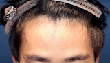 30代 男性 Y.M.さん 生え際 自毛植毛（MIRAI法）600株の症例｜自毛植毛の症例（手術前）
