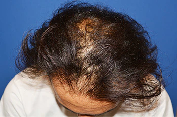 30代 男性 N.H.さん 生え際・頭頂部 自毛植毛（MIRAI法）2,000株の症例｜自毛植毛の症例（手術前の状態）