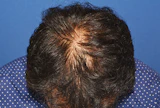 340代 男性 N.T.さん 前頭部・頭頂部 自毛植毛（MIRAI法）2,200株の症例｜自毛植毛の症例（手術後）