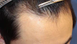 20代 男性  K.G.さん 生え際 自毛植毛（MIRAI法）1,600株の症例｜自毛植毛の症例（手術前）
