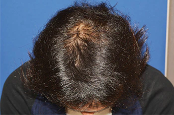 30代 男性 N.H.さん 生え際・頭頂部 自毛植毛（MIRAI法）2,000株の症例｜自毛植毛の症例（術後6ヶ月の経過）