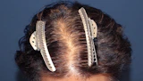 50代 男性 T.U.さん 前頭部 自毛植毛（MIRAI法）2,000株の症例｜自毛植毛の症例（手術前）
