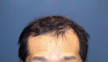 40代 男性 N.T.さん 生え際 自毛植毛（MIRAI法）3,000株の症例｜自毛植毛の症例（1回目手術前）