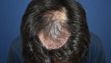 40代 男性  I.M.さん 前頭部・頭頂部・つむじ 自毛植毛（MIRAI法）2,500株の症例｜自毛植毛の症例（手術前）