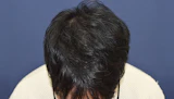 30代 男性 M.Y.さん 頭頂部・つむじ 自毛植毛（MIRAI法）1,800株の症例｜自毛植毛の症例（手術後）