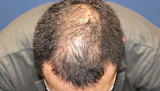 30代 男性 S.Y.さん 前頭部 頭頂部 自毛植毛（MIRAI法）2,300株の症例｜自毛植毛の症例（手術前）