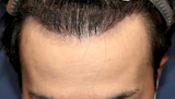 20代 男性 Y.A.さん 生え際 自毛植毛（MIRAI法）1,500株の症例｜自毛植毛の症例（手術後）