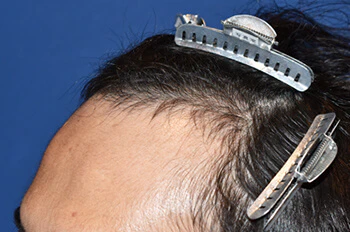 30代 男性 I.N.さん 生え際 自毛植毛（MIRAI法）800株の症例｜自毛植毛の症例（手術前）