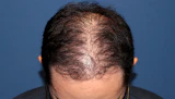 40代 男性  K.N.さん 生え際 前頭部  頭頂部 つむじ 自毛植毛（MIRAI法）3,000株の症例｜自毛植毛の症例（手術後）