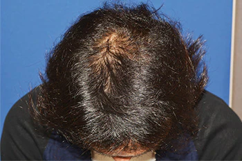 30代 男性 N.H.さん 生え際・頭頂部 自毛植毛（MIRAI法）2,000株の症例｜自毛植毛の症例（術後6ヶ月）