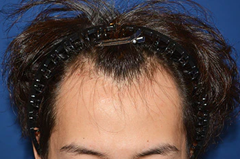 20代 男性 S.T.さん 生え際 自毛植毛（MIRAI法） 2,000株の症例｜自毛植毛の症例（手術前）