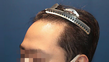 30代 男性 H.H.さん 生え際 自毛植毛（MIRAI法）1,500株の症例｜自毛植毛の症例（手術前：左側）