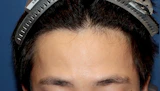 30代 男性 Y.M.さん 生え際 自毛植毛（MIRAI法）600株の症例｜自毛植毛の症例（手術後）