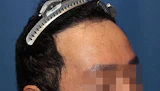 40代 男性 Y.N.さん 生え際 自毛植毛（MIRAI法）1,600株の症例｜自毛植毛の症例（手術後）