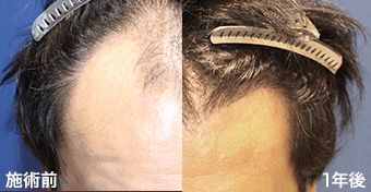 生え際の自毛植毛の症例