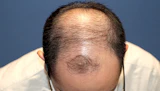 40代 男性  K.N.さん 生え際 前頭部  頭頂部 つむじ 自毛植毛（MIRAI法）3,000株の症例｜自毛植毛の症例（手術前）
