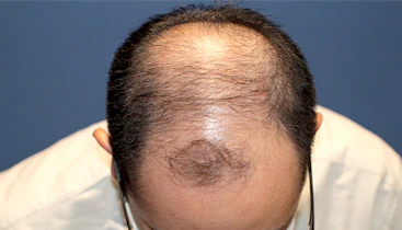 40代 男性  K.N.さん 生え際 前頭部  頭頂部 つむじ 自毛植毛（MIRAI法）3,000株の症例｜自毛植毛の症例（手術前）