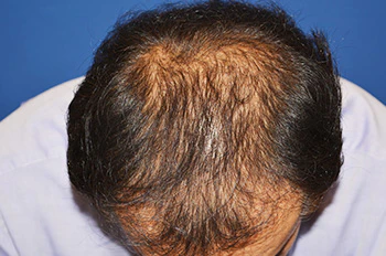40代 男性 N.T.さん 前頭部・頭頂部 自毛植毛（MIRAI法）2,200株の症例（手術前の状態）