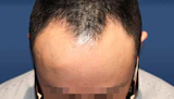 40代 男性  K.S.さん 生え際 自毛植毛（MIRAI法）1,500株の症例｜自毛植毛の症例（手術前）