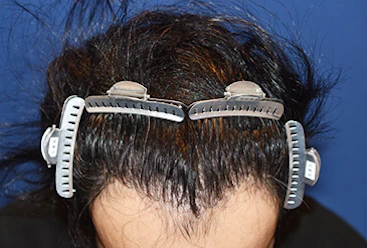 30代 男性 S.T.さん 前頭部～頭頂部 自毛植毛（MIRAI法）1,500株の症例（手術後）