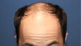 30代 男性 K.K.さん 生え際 自毛植毛（MIRAI法）3,000株の症例｜自毛植毛の症例（手術前）