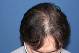 50代 男性 H.M.さん 生え際・前頭部・頭頂部 自毛植毛（MIRAI法）2,000株の症例｜自毛植毛の症例（手術後）